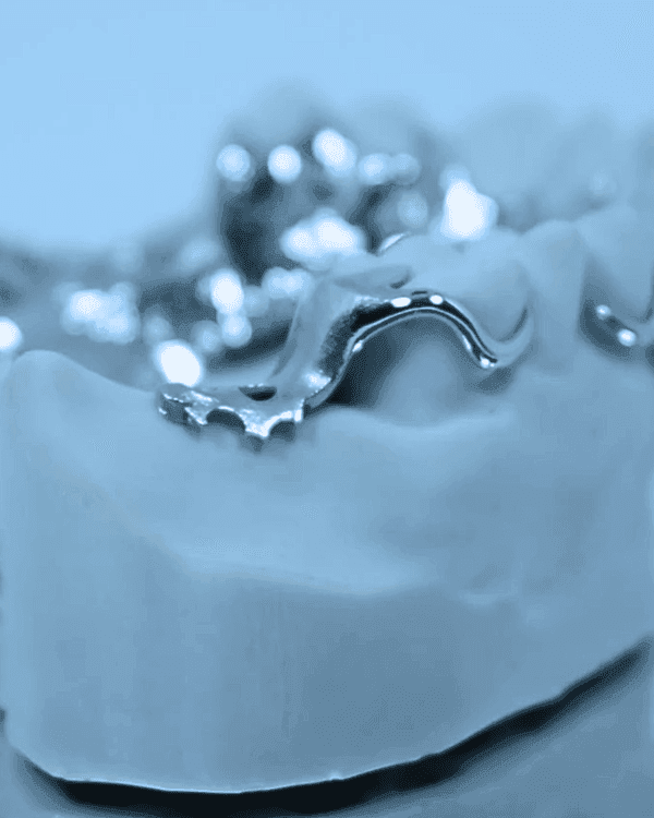 Metal RPD - Denture Kerangka Logam