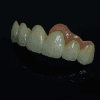 Zirconia Layer - PFZ