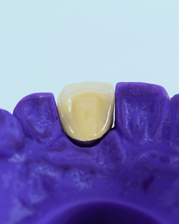 Porcelain Fused to Metal