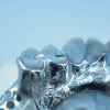 Metal RPD - Denture Kerangka Logam