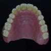 Acrylic Denture