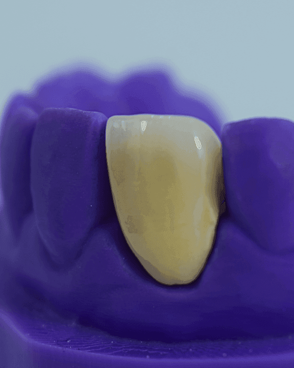 Porcelain Fused to Metal