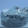 Metal RPD - Denture Kerangka Logam