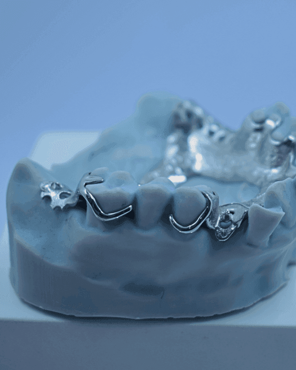 Metal RPD - Denture Kerangka Logam