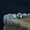 Porcelain Fused to Metal