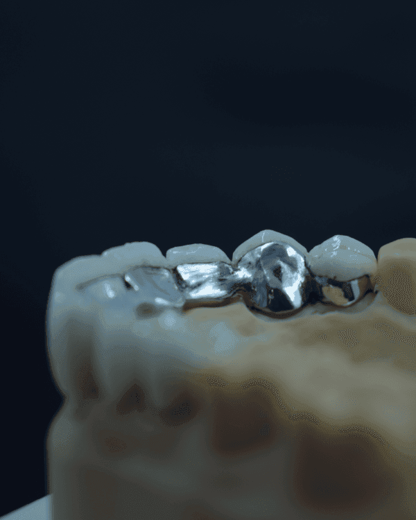 Porcelain Fused to Metal
