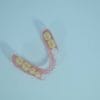 Rigid Thermoplastic Denture