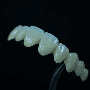 Porcelain Fused to Metal