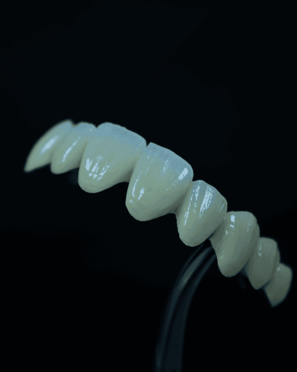 Porcelain Fused to Metal