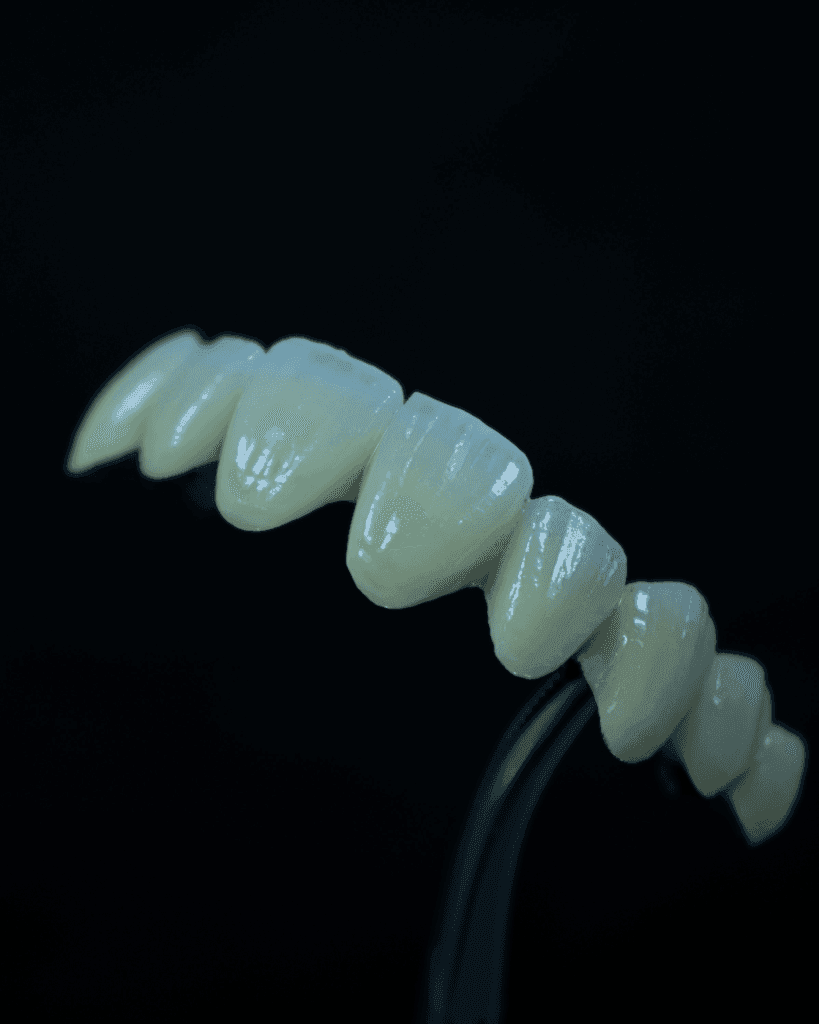 Porcelain Fused to Metal