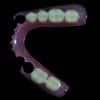 Rigid Thermoplastic Denture