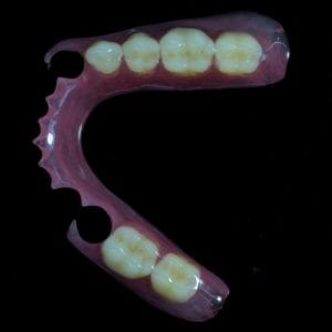 Rigid Thermoplastic Denture