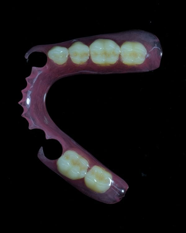 Rigid Thermoplastic Denture