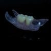 Flexible Nylon Denture