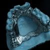 Metal RPD - Denture Kerangka Logam