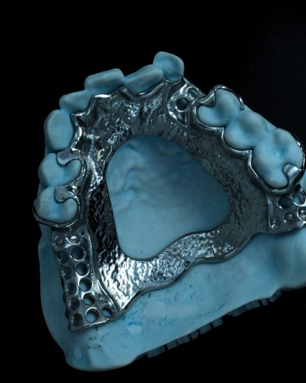 Metal RPD - Denture Kerangka Logam
