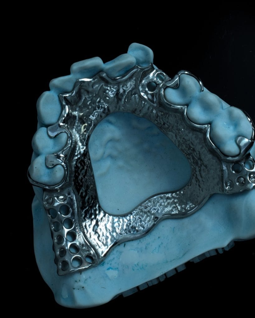 Metal RPD - Denture Kerangka Logam