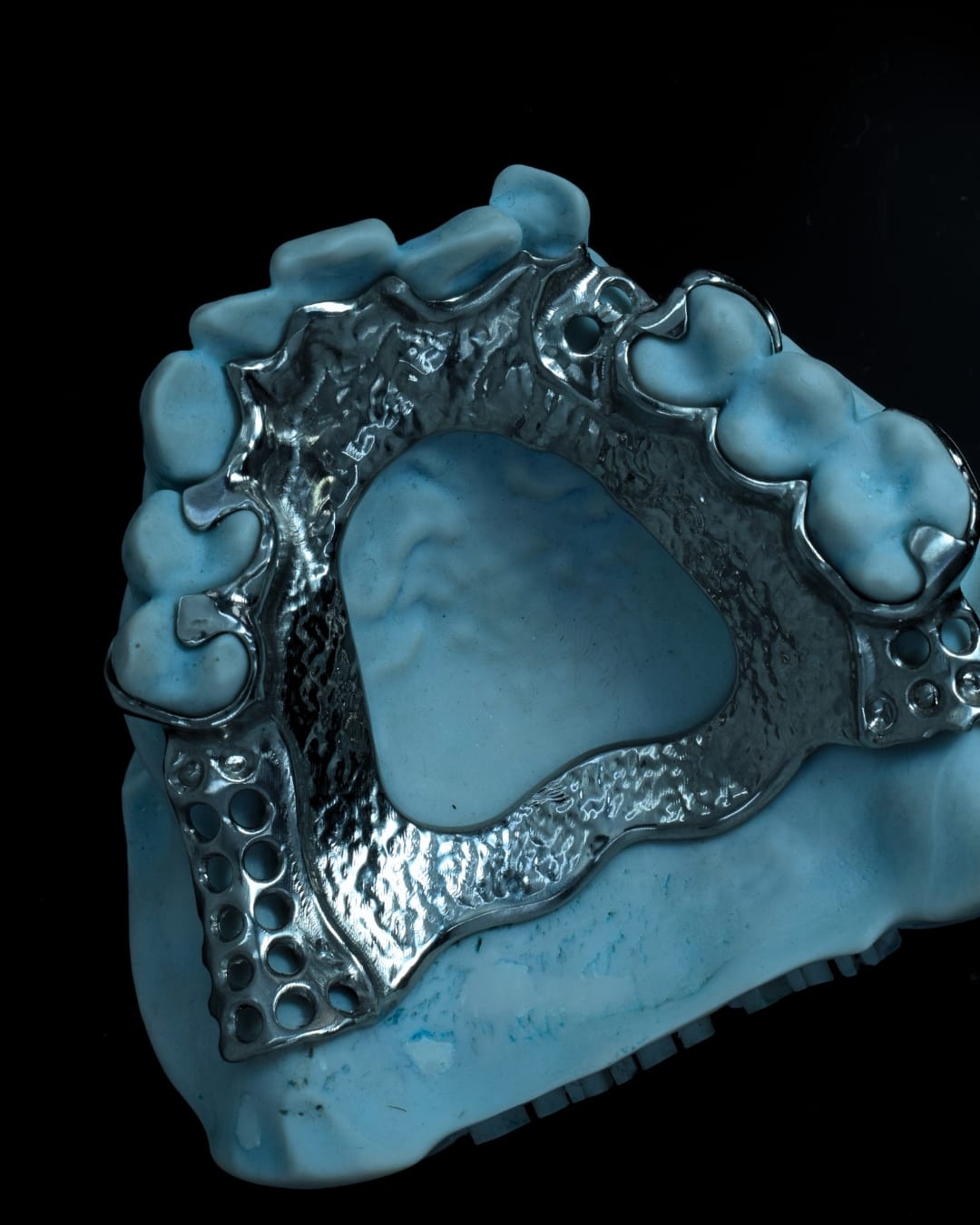 Metal RPD - Denture Kerangka Logam - Oentoe Apik